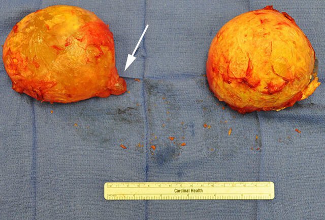 capsular contracture before and after