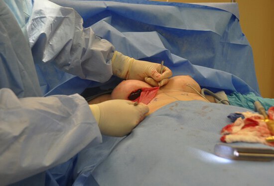 Surgeon showing biologic mesh placement