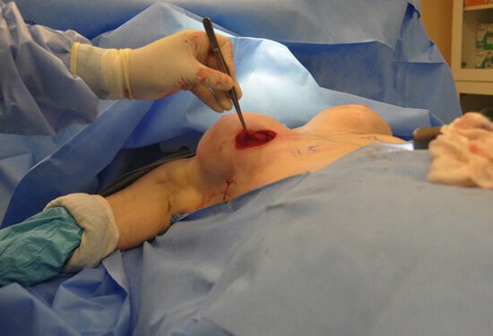 Surgeon pointing to breast pocket intraoperatively.
