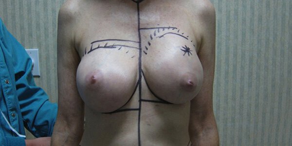 Properative markings on patient's body showing breast assymetry.
