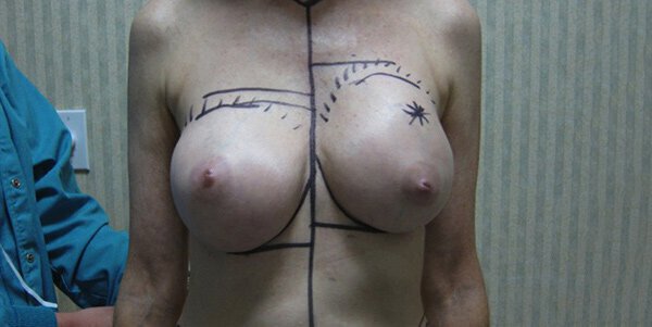 internal bra breast augmentation before and after