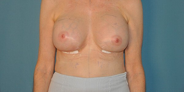 Patient results immediately post-opertative showing placement of bandages.
