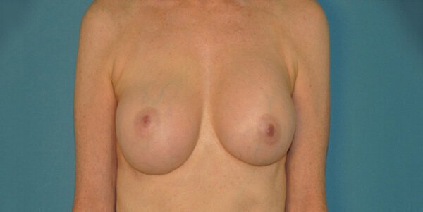 Before photo of Vero Beach internal bra procedure