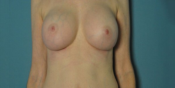 After internal bra plastic surgery procedure showing results.