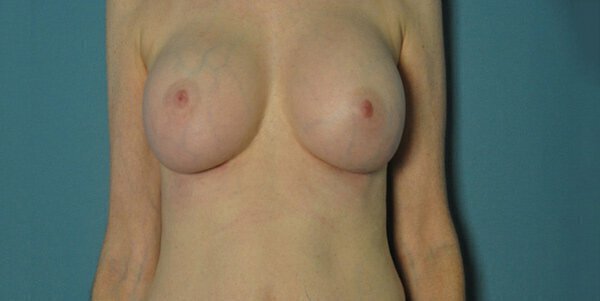 internal bra breast augmentation before and after