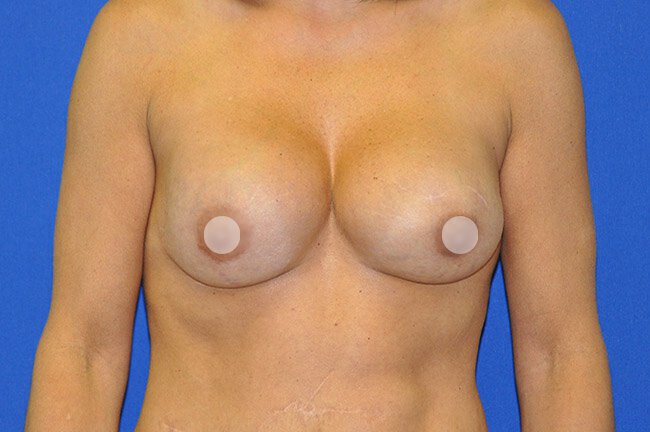Illustrates capsular contracture of two breasts.