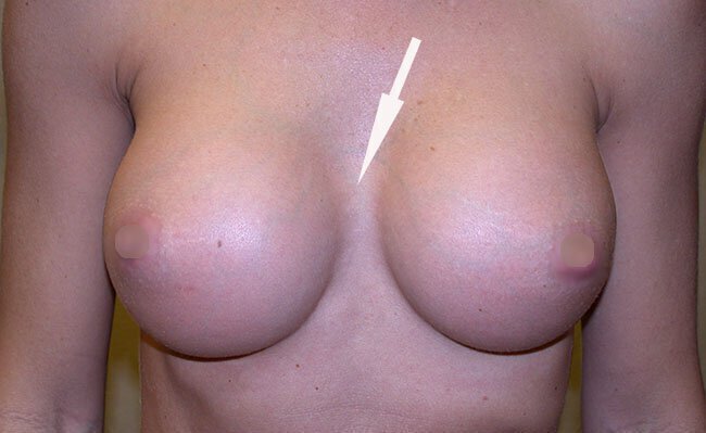 Female patient's chest with white arrow showing space between two breasts.