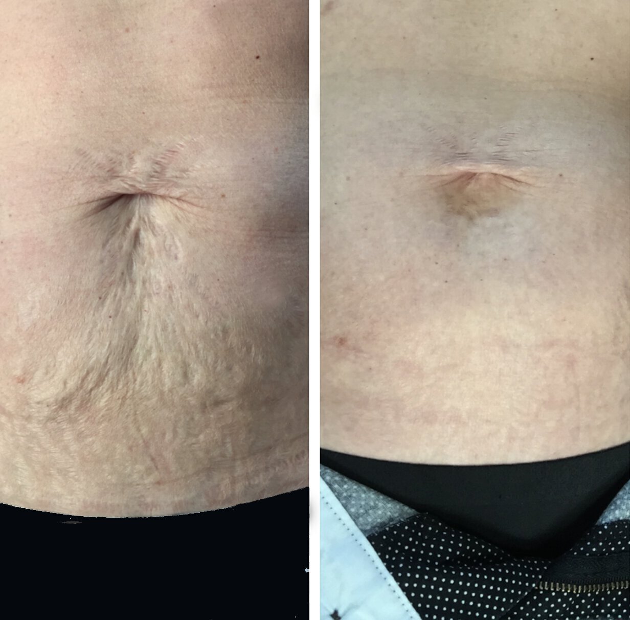 Fractional Laser Before and after