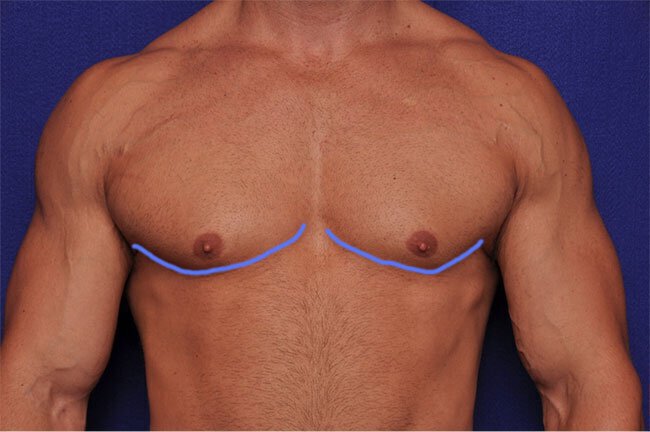 Bodybuilder with Gynecomastia