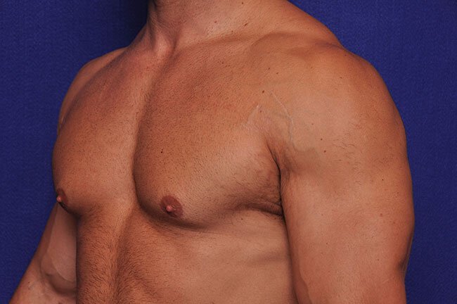 Before gynecomastia surgery at Vero Beach