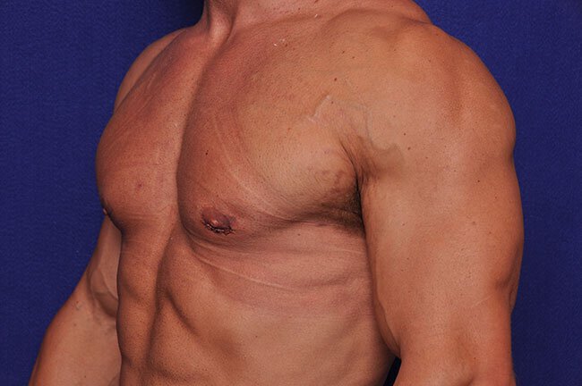 After gynecomastia surgery at Vero Beach