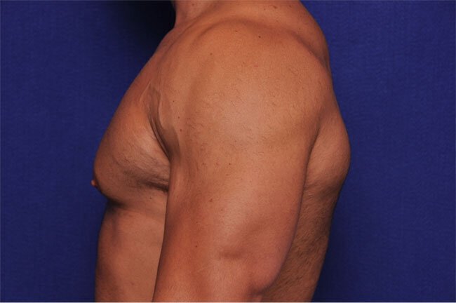 Before gynecomastia surgery at Vero Beach