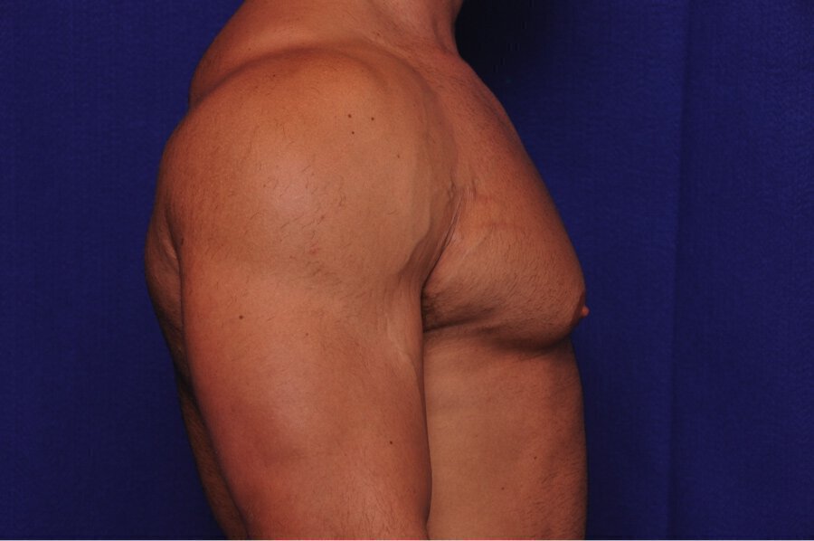 Before gynecomastia surgery at Vero Beach