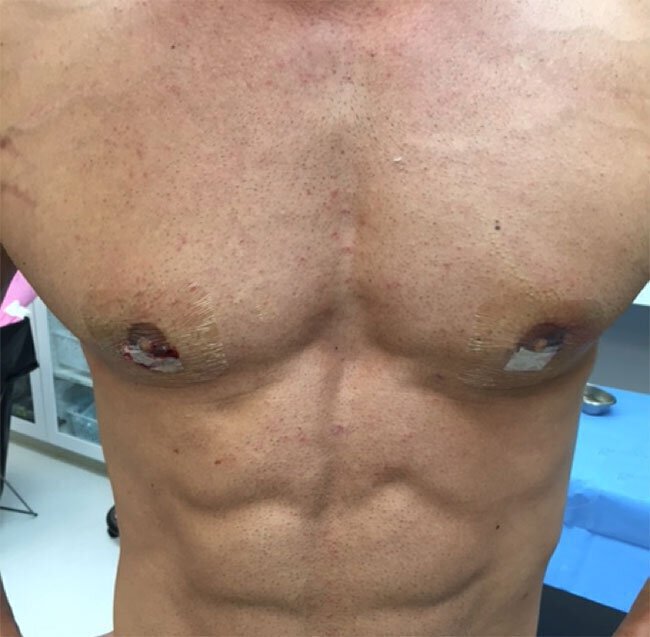 Post gynecomastia surgery Vero Beach