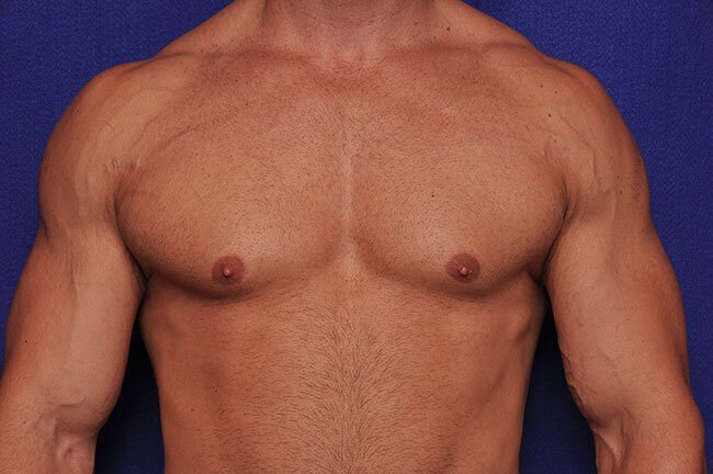 Before gynecomastia surgery at Vero Beach