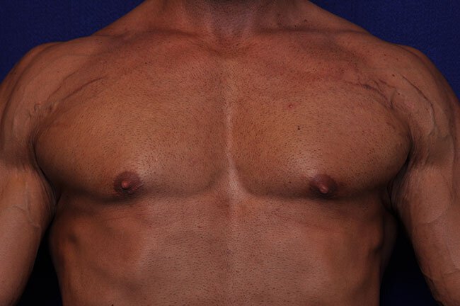 After gynecomastia surgery at Vero Beach