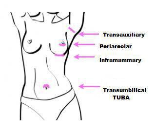 Breast augmentation graphic info