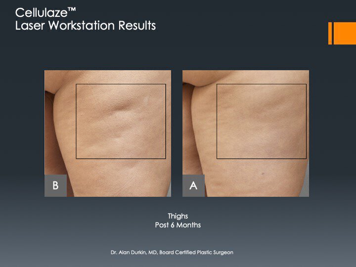 Cellulite before and after photos from Vero Beach