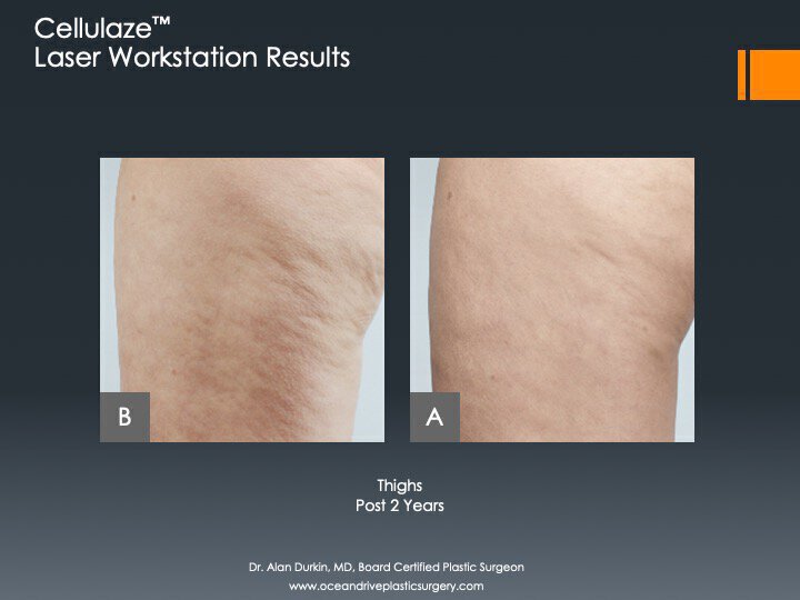 Cellulaze before and after photo