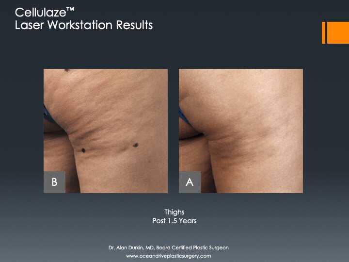 Cellulaze before and after photo