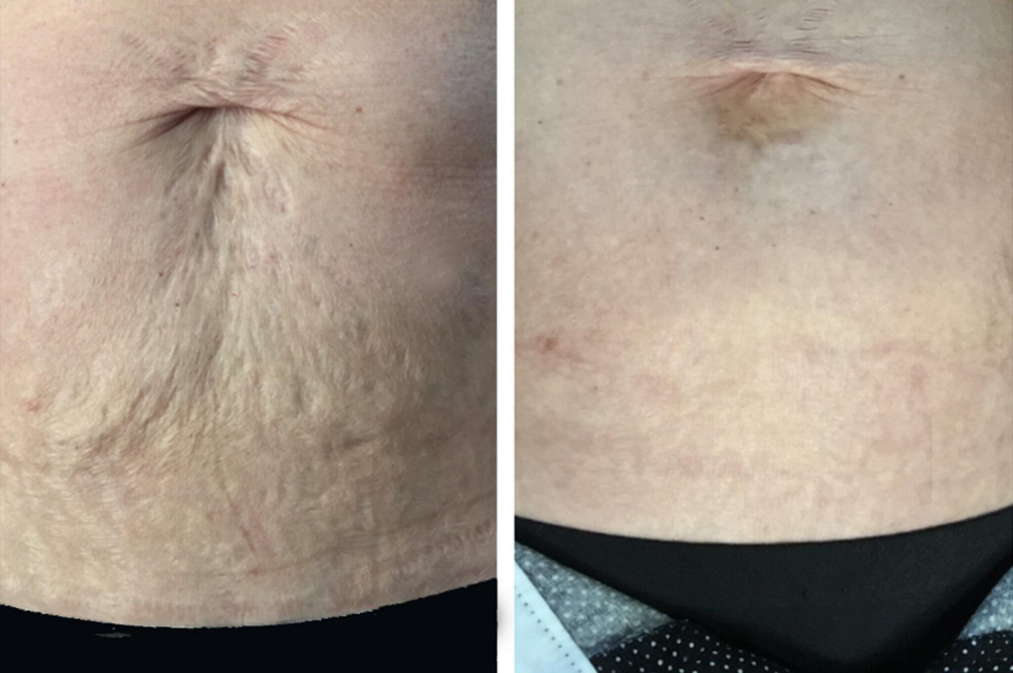 Fractional laser resurfacing patient before and after treatment