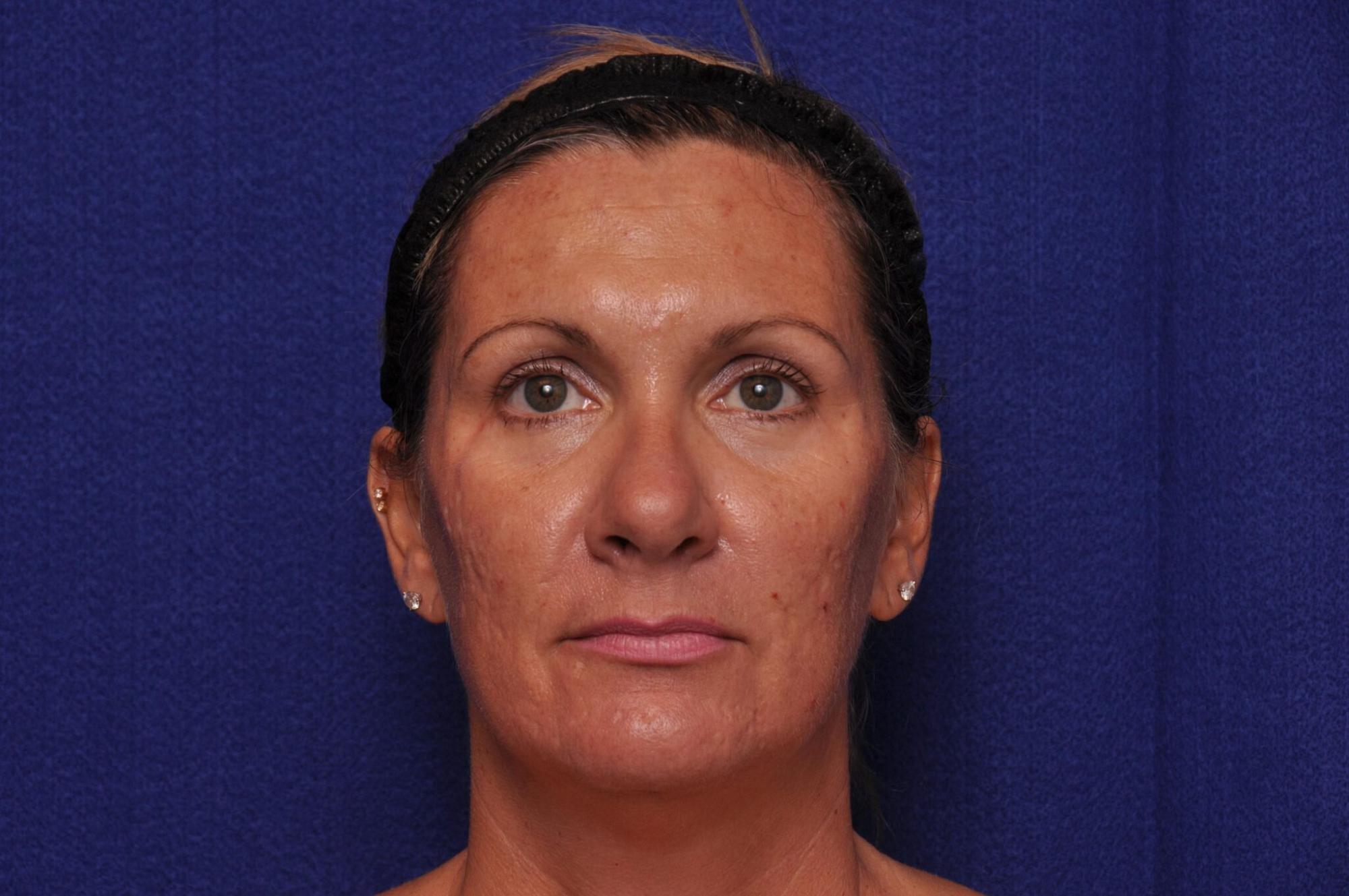 Vero Beach Skin resurfacing patient