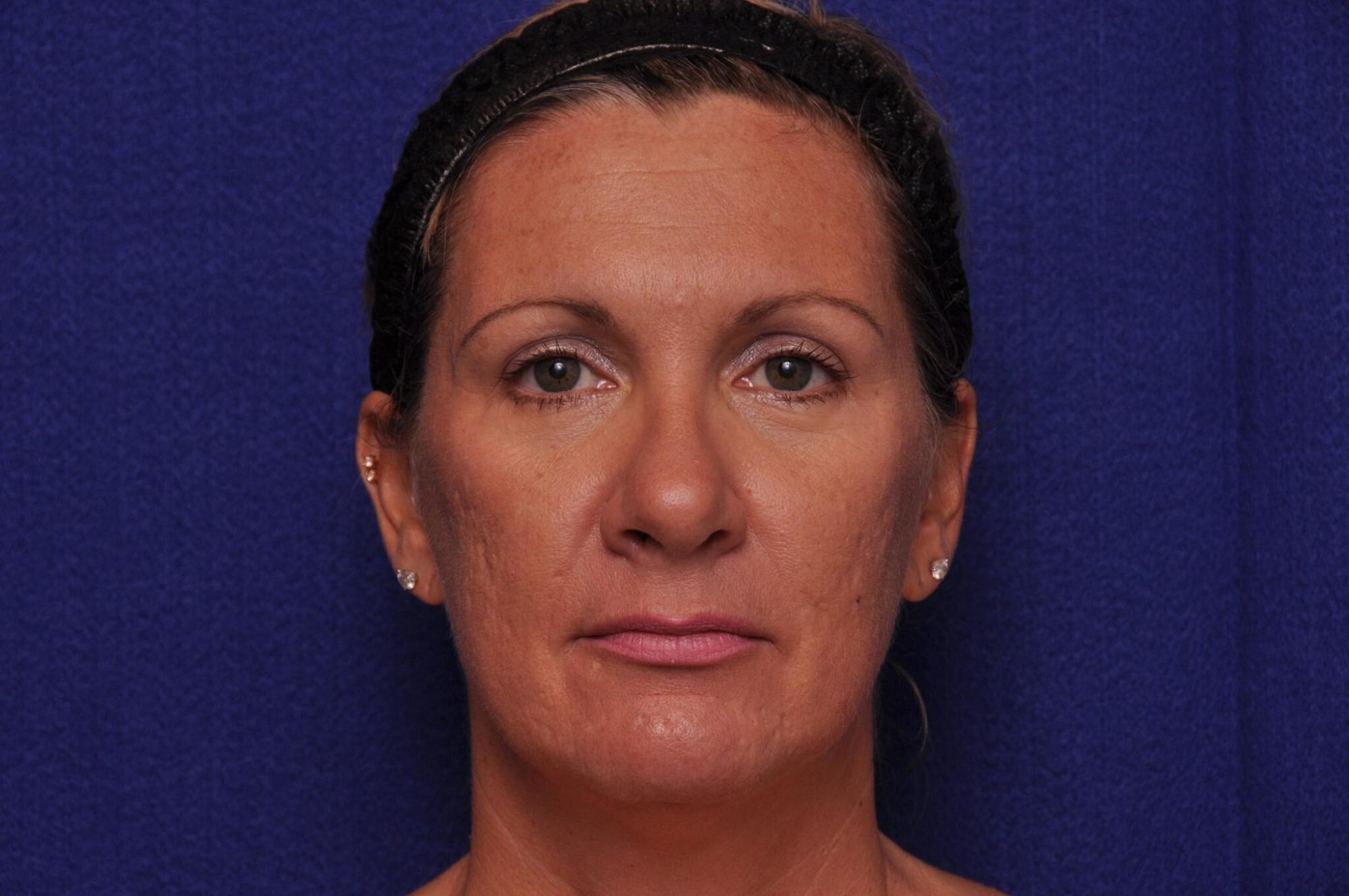 Vero Beach Skin rejuvenation patient