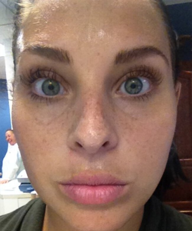 Close up of Vero Beach patient's face