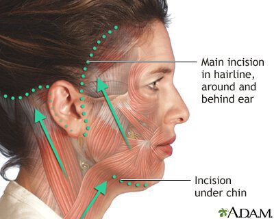 Figure 1 – Full Facelift Incision – This approach allows for comprehensive rejuvenation of the upper face, mid face, lower face, neck, and lateral face/brow. Incisions are placed inside the ear in front, and within the ear crease posteriorly behind the ear.