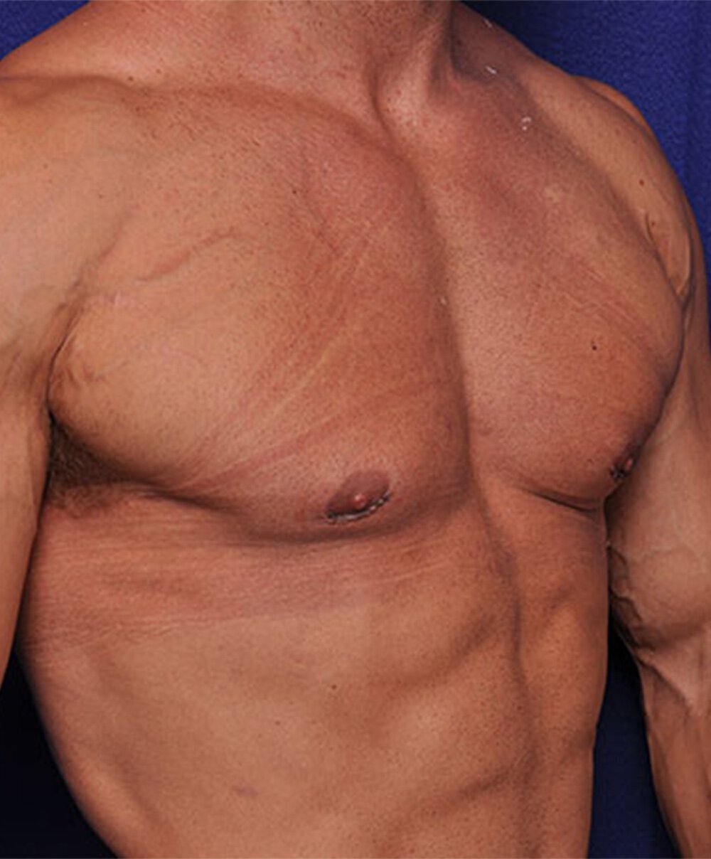 Gynecomastia surgery results on Vero Beach patient