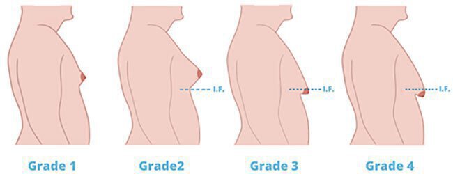 Grades of Gynecomastia