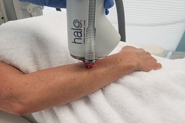 Vero beach HALO Laser applied to model's arm