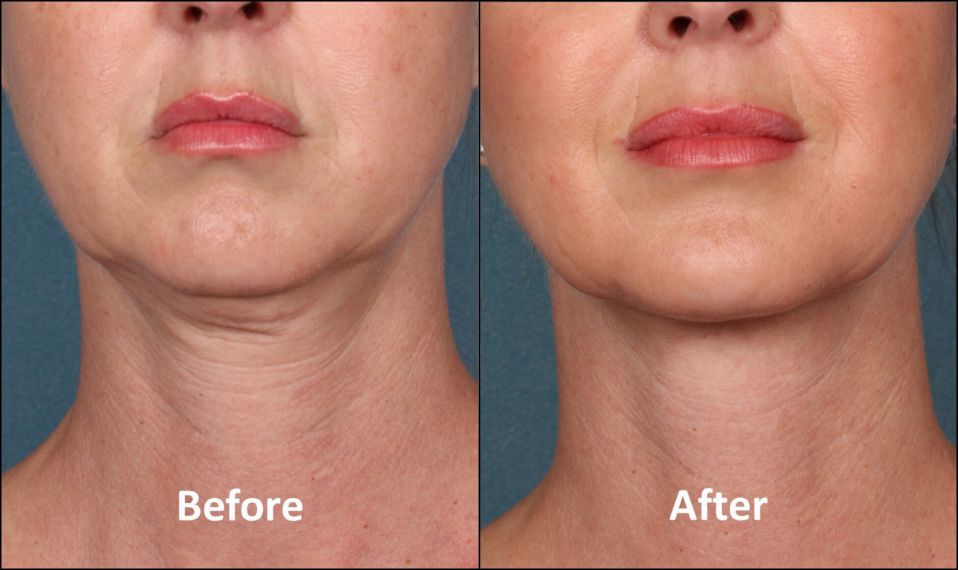 Before and after photos of a Vero Beach kybella treatment