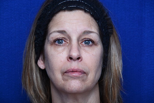 Vero Beach patient before facelift