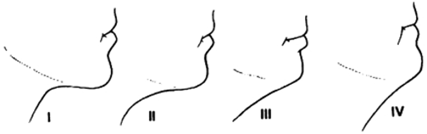 Neck Contour infographic