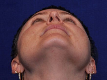 Diagram of Nose Anatomy and Nasofacial Angles