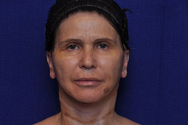 Vero Beach patient 1 day after facelift