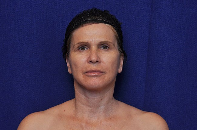 Vero Beach patient 10 days after facelift