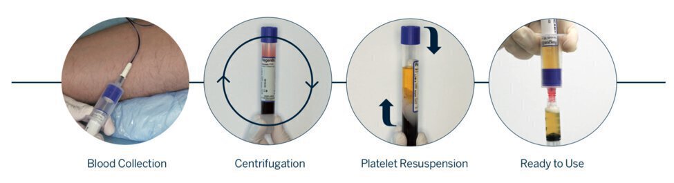 Info graphic of process for collecting platelet rich plasma