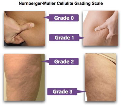 Cellulite grading scale info graphics