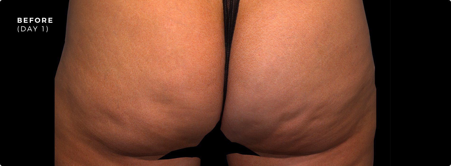 Cellulite before photo on Vero Beach patient