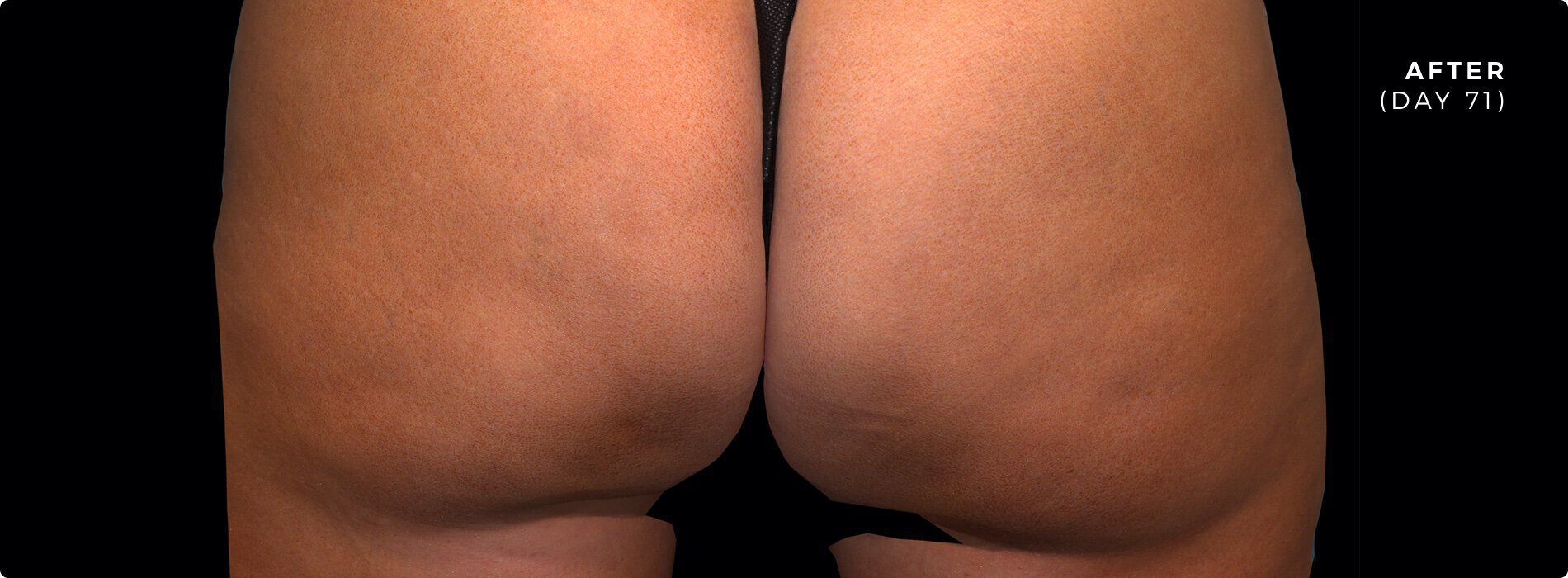 Cellulite after photo on Vero Beach patient