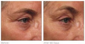 Ultherapy before and after