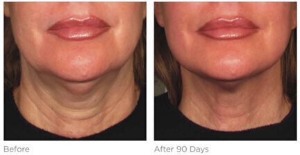 Ultherapy before and after