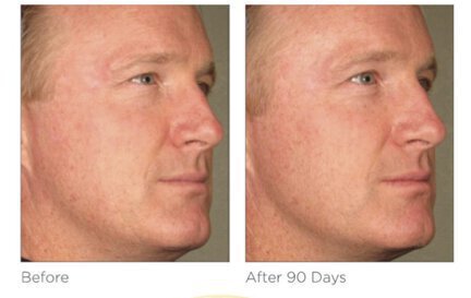 Ultherapy before and after