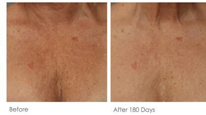 Ultherapy before and after