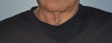 Front of patient's neck before Vero Beach neck lift