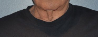 neck lift for men before & after photo