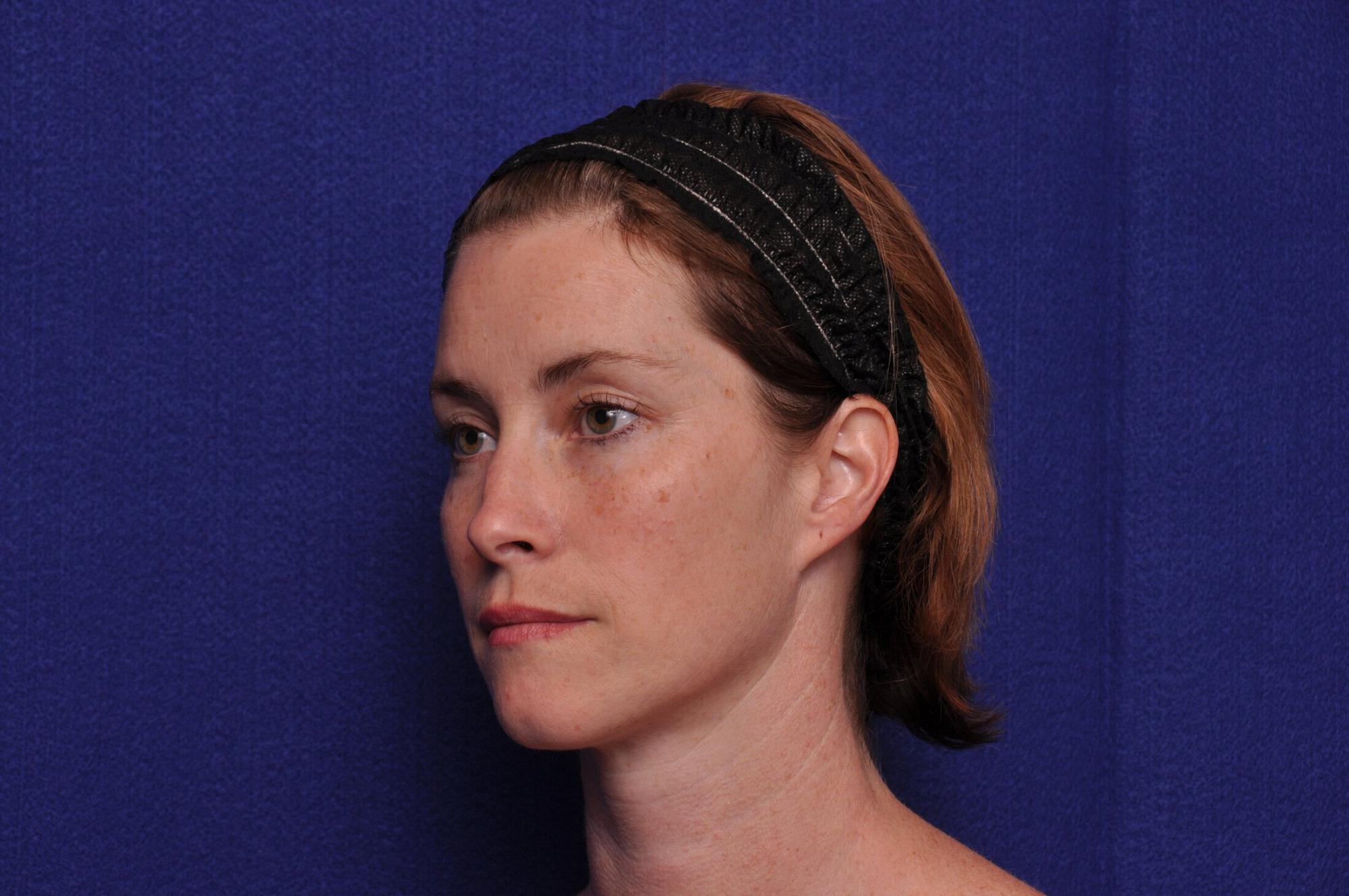 Before photo of Vero Beach patient's torso