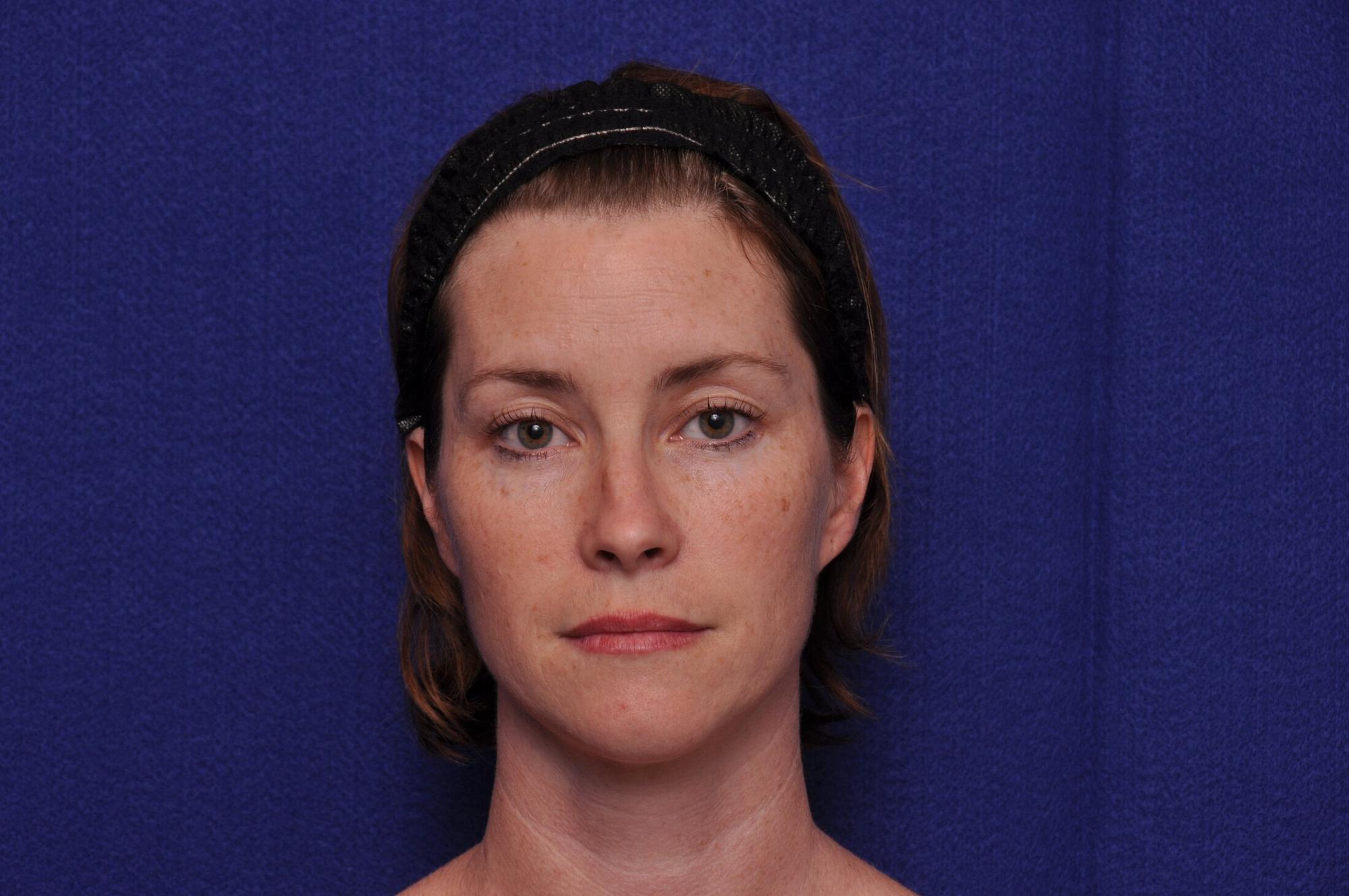 After photo of Vero Beach patient's torso